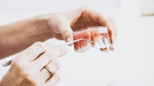 Dental implants step by step
