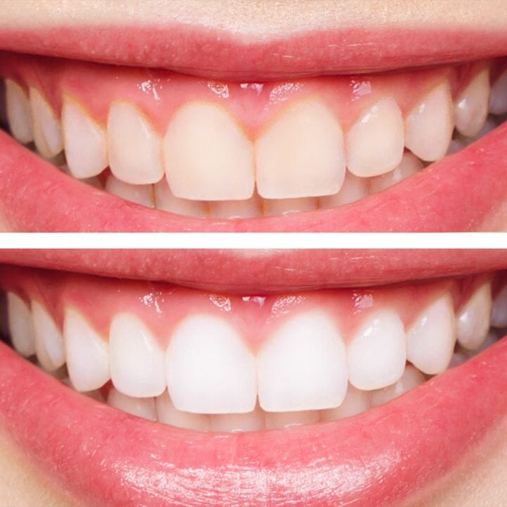 Before (top) and after (bottom) of teeth whitening example