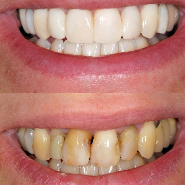 Before (bottom) and after (top) of teeth cleaning and veneers