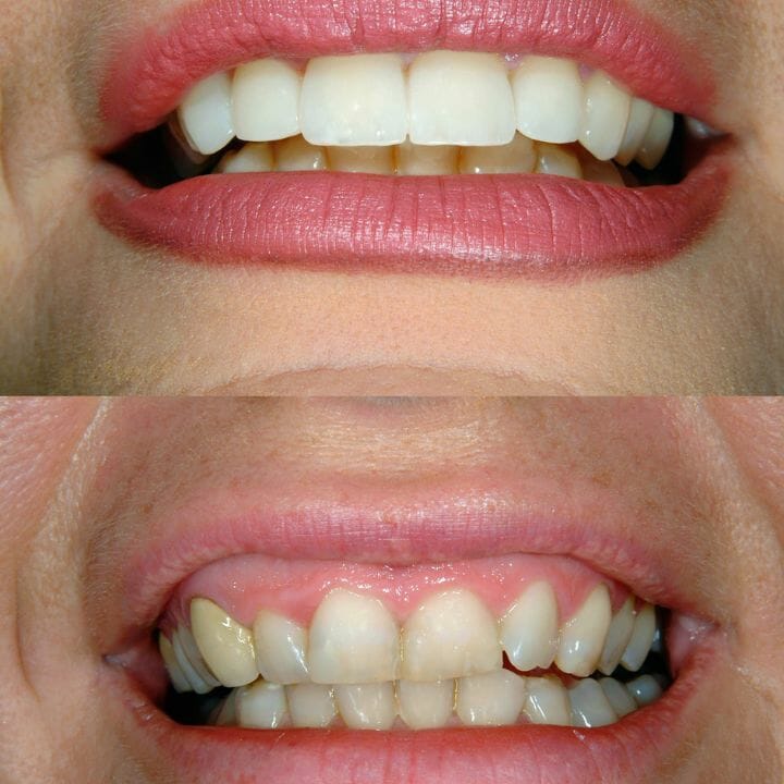 Before (bottom) and after (top) of front tooth veneers